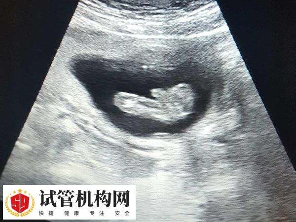 怀孕三胎后可以不减胎