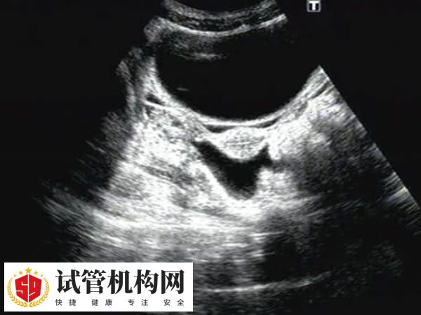 鲜胚移植后宫腔积液的吸收时间因人而异