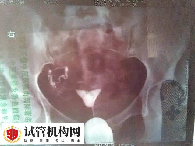 输卵管结扎并不影响试管过程的核心操作